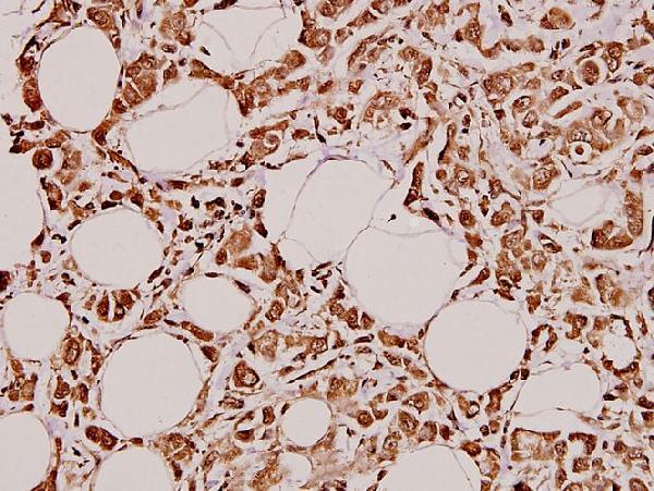 Immunohistochemistry (IHC) analyzes of GCS-α-1 (D423) pAb in paraffin-embedded human breast carcinoma tissue at 1:100