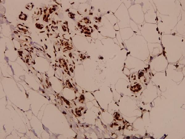 Immunohistochemistry (IHC) analyzes of PARK2 / Parkin (T125) pAb in paraffin-embedded human breast carcinoma tissue at 1:50
