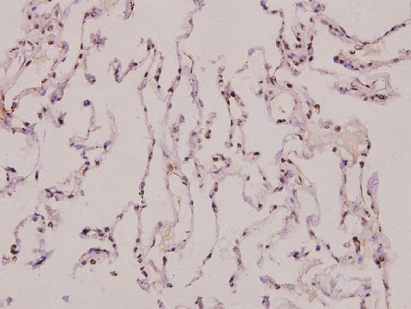 Immunohistochemistry (IHC) analyzes of ATP5J2 (G42) pAb in paraffin-embedded human lung carcinoma tissue at 1:100
