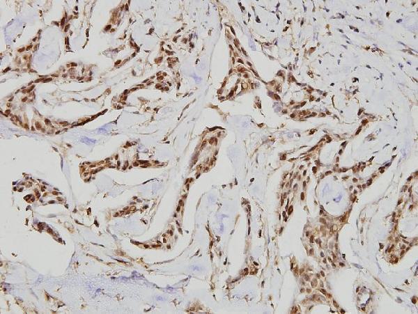 Immunohistochemistry (IHC) analyzes of GCS-β-1 (V21) pAb in paraffin-embedded human breast carcinoma tissue at 1:100