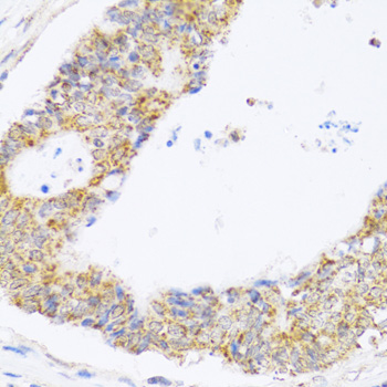 Immunohistochemistry of paraffin-embedded human colon carcinoma using ZAK antibody  at dilution of 1:100 