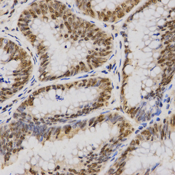 Immunohistochemistry of paraffin-embedded human breast cancer using SKIV2L2 antibody  at dilution of 1:100 