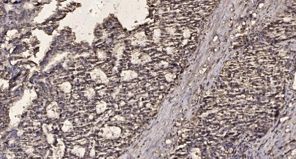 Immunohistochemical analysis of paraffin-embedded human liver cancer
