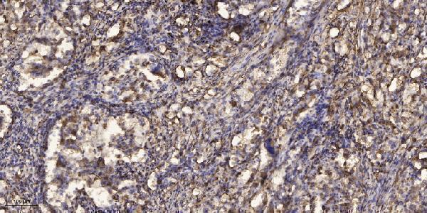 Immunohistochemical analysis of paraffin-embedded human Squamous cell carcinoma of lung