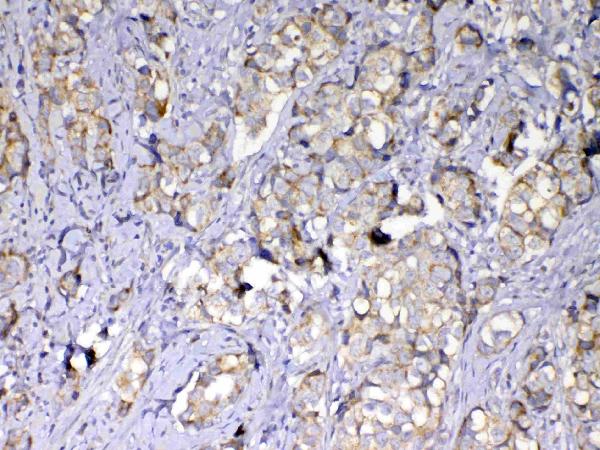 IHC analysis of MMP10 using anti-MMP10 antibody (A03759-1). MMP10 was detected in paraffin-embedded section of human mammary cancer tissue. Heat mediated antigen retrieval was performed in citrate buffer (pH6, epitope retrieval solution) for 20 mins. The tissue section was blocked with 10% goat serum. The tissue section was then incubated with 1μg/ml rabbit anti-MMP10 Antibody (A03759-1) overnight at 4°C. Biotinylated goat anti-rabbit IgG was used as secondary antibody and incubated for 30 minutes at 37°C. The tissue section was developed using Strepavidin-Biotin-Complex (SABC)(Catalog # SA1022) with DAB as the chromogen.