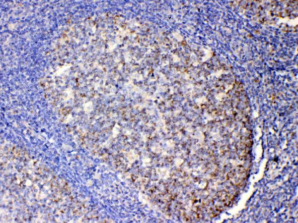 Figure 2. IHC analysis of IL13 using anti-IL13 antibody (A00077). IL13 was detected in paraffin-embedded section of human tonsil tissues. Heat mediated antigen retrieval was performed in citrate buffer (pH6, epitope retrieval solution) for 20 mins. The tissue section was blocked with 10% goat serum. The tissue section was then incubated with 1microg/ml rabbit anti-IL13 Antibody (A00077) overnight at 4°C. Biotinylated goat anti-rabbit IgG was used as secondary antibody and incubated for 30 minutes at 37°C. The tissue section was developed using Strepavidin-Biotin-Complex (SABC)(Catalog # SA1022) with DAB as the chromogen.