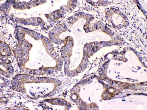 Figure 2. IHC analysis of Calpastatin using anti-Calpastatin antibody (A00337). Calpastatin was detected in paraffin-embedded section of human intestinal cancer tissues. Heat mediated antigen retrieval was performed in citrate buffer (pH6, epitope retrieval solution) for 20 mins. The tissue section was blocked with 10% goat serum. The tissue section was then incubated with 1microg/ml rabbit anti-Calpastatin Antibody (A00337) overnight at 4°C. Biotinylated goat anti-rabbit IgG was used as secondary antibody and incubated for 30 minutes at 37°C. The tissue section was developed using Strepavidin-Biotin-Complex (SABC)(Catalog # SA1022) with DAB as the chromogen.