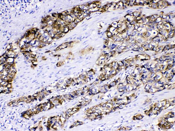Figure 3. IHC analysis of Cytokeratin 5 using anti-Cytokeratin 5 antibody (A00398). Cytokeratin 5 was detected in paraffin-embedded section of human oesophagus squama cancer tissues. Heat mediated antigen retrieval was performed in citrate buffer (pH6, epitope retrieval solution) for 20 mins. The tissue section was blocked with 10% goat serum. The tissue section was then incubated with 1microg/ml rabbit anti-Cytokeratin 5 Antibody (A00398) overnight at 4°C. Biotinylated goat anti-rabbit IgG was used as secondary antibody and incubated for 30 minutes at 37°C. The tissue section was developed using Strepavidin-Biotin-Complex (SABC)(Catalog # SA1022) with DAB as the chromogen.