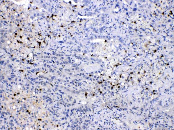 IHC analysis of NEDD8 using anti-NEDD8 antibody (A00547). NEDD8 was detected in paraffin-embedded section of human lung cancer tissues. Heat mediated antigen retrieval was performed in citrate buffer (pH6, epitope retrieval solution) for 20 mins. The tissue section was blocked with 10% goat serum. The tissue section was then incubated with 1μg/ml rabbit anti-NEDD8 Antibody (A00547) overnight at 4°C. Biotinylated goat anti-rabbit IgG was used as secondary antibody and incubated for 30 minutes at 37°C. The tissue section was developed using Strepavidin-Biotin-Complex (SABC)(Catalog # SA1022) with DAB as the chromogen.