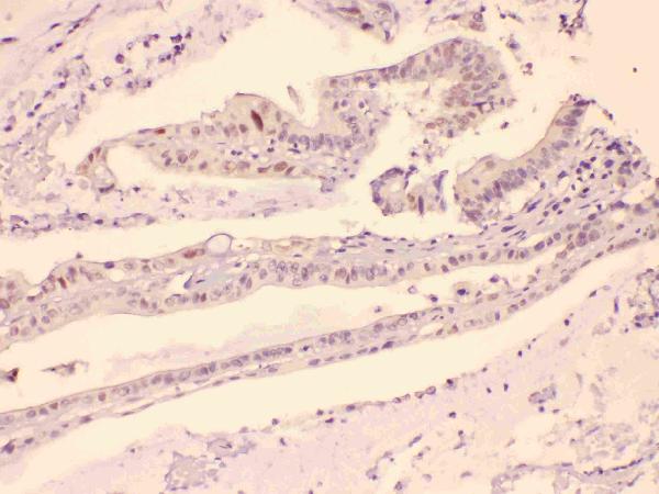 Figure 4. IHC analysis of HDGF using anti-HDGF antibody (A01057). HDGF was detected in paraffin-embedded section of human intestinal cancer tissues. Heat mediated antigen retrieval was performed in citrate buffer (pH6, epitope retrieval solution) for 20 mins. The tissue section was blocked with 10% goat serum. The tissue section was then incubated with 1microg/ml rabbit anti-HDGF Antibody (A01057) overnight at 4°C. Biotinylated goat anti-rabbit IgG was used as secondary antibody and incubated for 30 minutes at 37°C. The tissue section was developed using Strepavidin-Biotin-Complex (SABC)(Catalog # SA1022) with DAB as the chromogen.