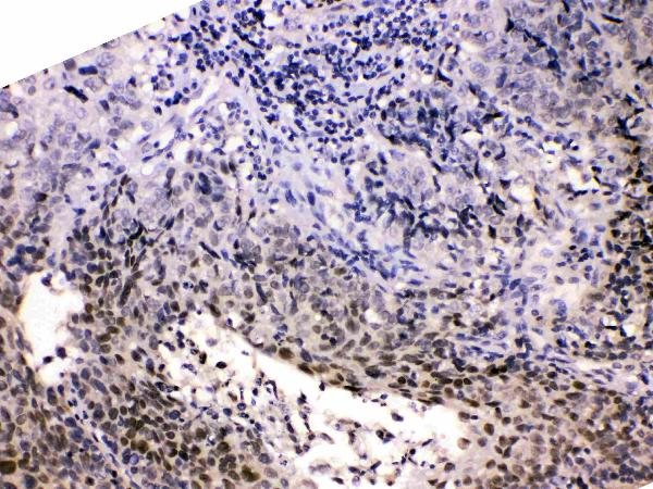 Figure 5. IHC analysis of HDGF using anti-HDGF antibody (A01057). HDGF was detected in paraffin-embedded section of human lung cancer tissues. Heat mediated antigen retrieval was performed in citrate buffer (pH6, epitope retrieval solution) for 20 mins. The tissue section was blocked with 10% goat serum. The tissue section was then incubated with 1microg/ml rabbit anti-HDGF Antibody (A01057) overnight at 4°C. Biotinylated goat anti-rabbit IgG was used as secondary antibody and incubated for 30 minutes at 37°C. The tissue section was developed using Strepavidin-Biotin-Complex (SABC)(Catalog # SA1022) with DAB as the chromogen.