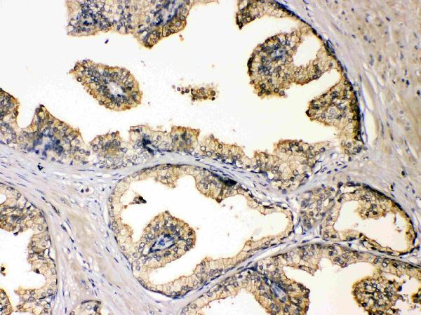 IHC analysis of DBI using anti-DBI antibody (A01267). DBI was detected in paraffin-embedded section of human prostatic cancer tissues. Heat mediated antigen retrieval was performed in citrate buffer (pH6, epitope retrieval solution) for 20 mins. The tissue section was blocked with 10% goat serum. The tissue section was then incubated with 1μg/ml rabbit anti-DBI Antibody (A01267) overnight at 4°C. Biotinylated goat anti-rabbit IgG was used as secondary antibody and incubated for 30 minutes at 37°C. The tissue section was developed using Strepavidin-Biotin-Complex (SABC)(Catalog # SA1022) with DAB as the chromogen.