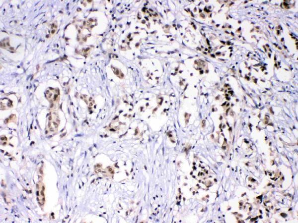 IHC analysis of HnRNPF using anti-HnRNPF antibody (A05806). HnRNPF was detected in paraffin-embedded section of human mammary cancer tissues. Heat mediated antigen retrieval was performed in citrate buffer (pH6, epitope retrieval solution) for 20 mins. The tissue section was blocked with 10% goat serum. The tissue section was then incubated with 1μg/ml rabbit anti-HnRNPF Antibody (A05806) overnight at 4°C. Biotinylated goat anti-rabbit IgG was used as secondary antibody and incubated for 30 minutes at 37°C. The tissue section was developed using Strepavidin-Biotin-Complex (SABC)(Catalog # SA1022) with DAB as the chromogen.