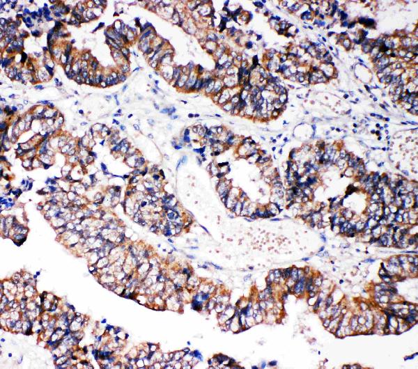 Anti-Caspase-3(P10), PA1302-1, IHC(P) IHC(P): Human Intestinal Cancer Tissue