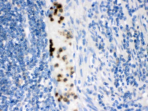 Cardiac FABP was detected in paraffin-embedded sections of human intestinal cancer tissues using rabbit anti-Cardiac FABP Antigen Affinity purified polyclonal antibody (Catalog # PA1336) at 1 μg/mL