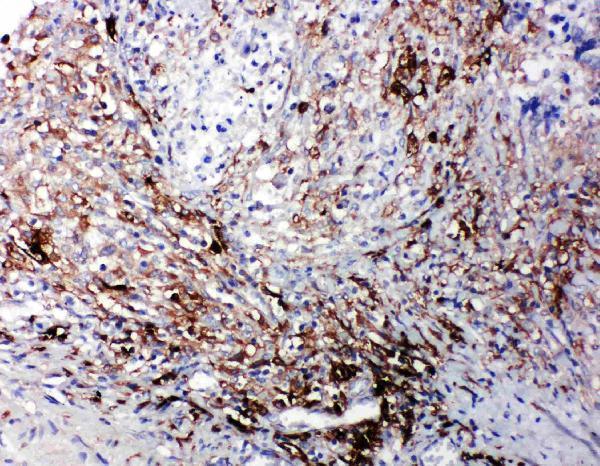 Anti-LTBR antibody, PA1968, IHC(P)IHC(P): Human Intestinal Cancer Tissue