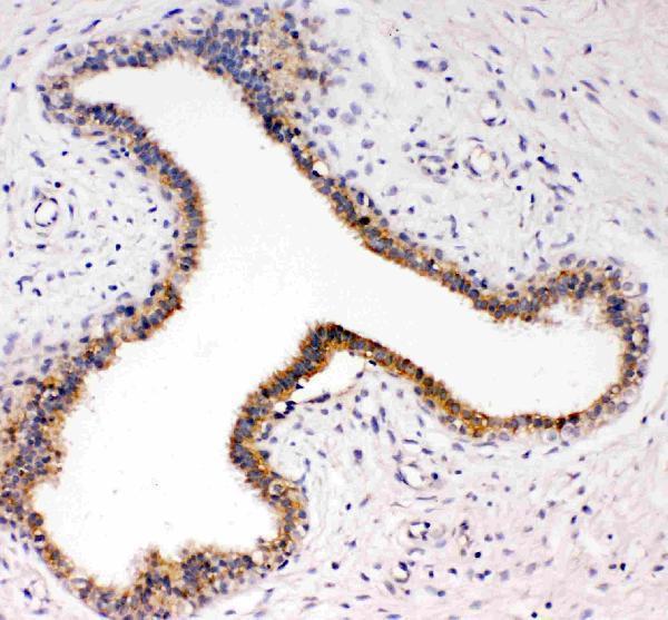 Anti-TrkC antibody, PA1992-1, IHC(P)IHC(P): Human Mammary Cancer Tissue