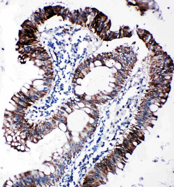 Anti-EIF2S1 antibody, PA2029, IHC(P)IHC(P): Human Intestinal Cancer Tissue