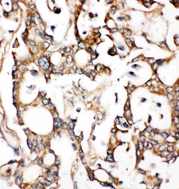Anti-ALDH2 antibody, PA2073, IHC(P)IHC(P): Human Liver Cancer Tissue