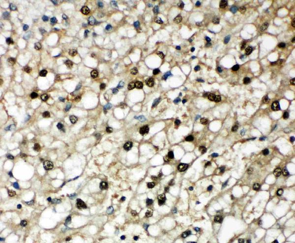 Anti-SBP/SELENBP1 antibody, PA2216, IHC(P)IHC(P): Human Liver Cancer Tissue