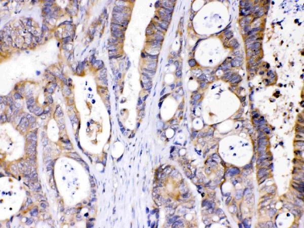Figure 2. IHC analysis of Abhd5 using anti-Abhd5 antibody (PB10021). Abhd5 was detected in paraffin-embedded section of human intestinal cancer tissues. Heat mediated antigen retrieval was performed in citrate buffer (pH6, epitope retrieval solution) for 20 mins. The tissue section was blocked with 10% goat serum. The tissue section was then incubated with 1microg/ml rabbit anti-Abhd5 Antibody (PB10021) overnight at 4°C. Biotinylated goat anti-rabbit IgG was used as secondary antibody and incubated for 30 minutes at 37°C. The tissue section was developed using Strepavidin-Biotin-Complex (SABC)(Catalog # SA1022) with DAB as the chromogen.