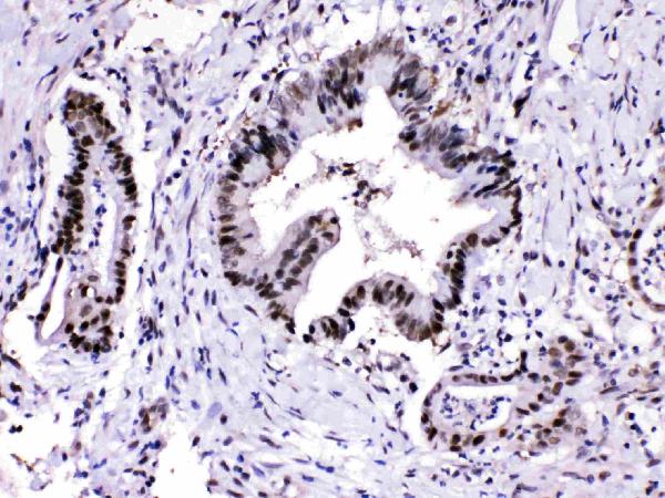 Figure 4. IHC analysis of PSMA3 using anti-PSMA3 antibody (PB10089). PSMA3 was detected in paraffin-embedded section of human intestinal cancer tissues. Heat mediated antigen retrieval was performed in citrate buffer (pH6, epitope retrieval solution) for 20 mins. The tissue section was blocked with 10% goat serum. The tissue section was then incubated with 1microg/ml rabbit anti-PSMA3 Antibody (PB10089) overnight at 4°C. Biotinylated goat anti-rabbit IgG was used as secondary antibody and incubated for 30 minutes at 37°C. The tissue section was developed using Strepavidin-Biotin-Complex (SABC)(Catalog # SA1022) with DAB as the chromogen.