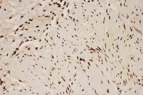 Anti-ALOX5 Picoband antibody, RP1031-3.JPG IHC(P): Human Intestinal Cancer Tissue Anti-ALOX5 Picoband antibody, RP1031-3.JPG IHC(P): Human Intestinal Cancer Tissue
