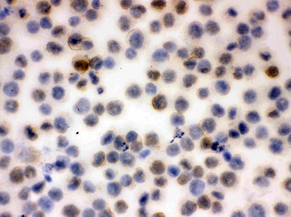 Figure 5. IHC analysis of CD43 using anti-CD43 antibody (PB9095). CD43 was detected in immunocytochemical section of K562 Cell. Enzyme antigen retrieval was performed using IHC enzyme antigen retrieval reagent (AR0022) for 15 mins. The cells were blocked with 10% goat serum. And then incubated with 1microg/ml rabbit anti-CD43 Antibody (PB9095) overnight at 4°C. Biotinylated goat anti-rabbit IgG was used as secondary antibody and incubated for 30 minutes at 37°C. The section was developed using Strepavidin-Biotin-Complex (SABC)(Catalog # SA1022) with DAB as the chromogen.