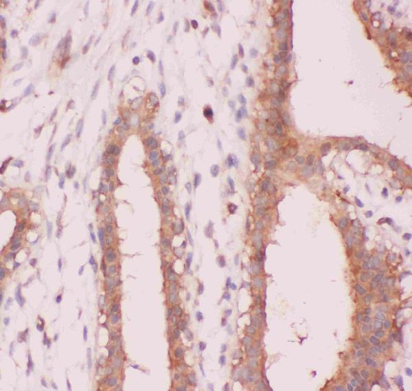 Figure 4. IHC analysis of NFkB/NFKB2 p100/p52 using anti-NFkB/NFKB2 p100/p52 antibody (PB9150). NFkB/NFKB2 p100/p52 was detected in a paraffin-embedded section of human mammary cancer tissue. Heat mediated antigen retrieval was performed in EDTA buffer (pH 8.0, epitope retrieval solution). The tissue section was blocked with 10% goat serum. The tissue section was then incubated with 1 microg/ml rabbit anti-NFkB/NFKB2 p100/p52 Antibody (PB9150) overnight at 4°C. Biotinylated goat anti-rabbit IgG was used as secondary antibody and incubated for 30 minutes at 37°C. The tissue section was developed using Strepavidin-Biotin-Complex (SABC) (Catalog # SA1022) with DAB as the chromogen.