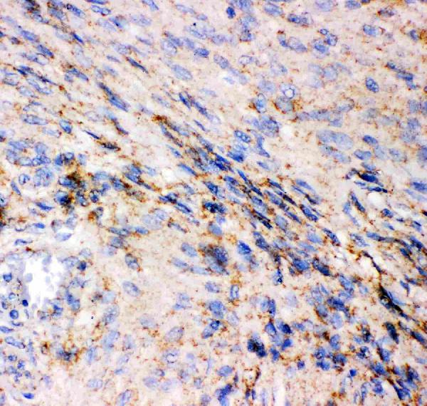 Figure 5. IHC analysis of GRIA1 using anti-GRIA1 antibody (PB9204). GRIA1 was detected in paraffin-embedded section of Human Meningeoma Tissue. Heat mediated antigen retrieval was performed in citrate buffer (pH6, epitope retrieval solution) for 20 mins. The tissue section was blocked with 10% goat serum. The tissue section was then incubated with 1microg/ml rabbit anti-GRIA1 Antibody (PB9204) overnight at 4°C. Biotinylated goat anti-rabbit IgG was used as secondary antibody and incubated for 30 minutes at 37°C. The tissue section was developed using Strepavidin-Biotin-Complex (SABC)(Catalog # SA1022) with DAB as the chromogen.