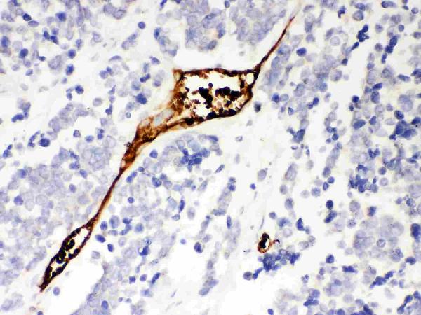 Figure 2. IHC analysis of Mesothelin using anti-Mesothelin antibody (PB9287). Mesothelin was detected in paraffin-embedded section of Human Lung Cancer Tissue. Heat mediated antigen retrieval was performed in citrate buffer (pH6, epitope retrieval solution) for 20 mins. The tissue section was blocked with 10% goat serum. The tissue section was then incubated with 1microg/ml rabbit anti-Mesothelin Antibody (PB9287) overnight at 4°C. Biotinylated goat anti-rabbit IgG was used as secondary antibody and incubated for 30 minutes at 37°C. The tissue section was developed using Strepavidin-Biotin-Complex (SABC)(Catalog # SA1022) with DAB as the chromogen.
