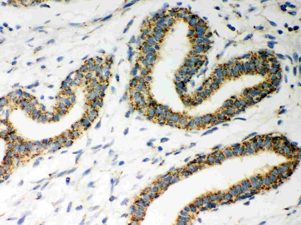 Figure 2. IHC analysis of ERAB using anti-ERAB antibody (PB9336). ERAB was detected in paraffin-embedded section of Human Mammary Cancer Tissue. Heat mediated antigen retrieval was performed in citrate buffer (pH6, epitope retrieval solution) for 20 mins. The tissue section was blocked with 10% goat serum. The tissue section was then incubated with 1microg/ml rabbit anti-ERAB Antibody (PB9336) overnight at 4°C. Biotinylated goat anti-rabbit IgG was used as secondary antibody and incubated for 30 minutes at 37°C. The tissue section was developed using Strepavidin-Biotin-Complex (SABC)(Catalog # SA1022) with DAB as the chromogen. Figure 2. IHC analysis of ERAB using anti-ERAB antibody (PB9336). ERAB was detected in paraffin-embedded section of Human Mammary Cancer Tissue. Heat mediated antigen retrieval was performed in citrate buffer (pH6, epitope retrieval solution) for 20 mins. The tissue section was blocked with 10% goat serum. The tissue section was then incubated with 1microg/ml rabbit anti-ERAB Antibody (PB9336) overnight at 4°C. Biotinylated goat anti-rabbit IgG was used as secondary antibody and incubated for 30 minutes at 37°C. The tissue section was developed using Strepavidin-Biotin-Complex (SABC)(Catalog # SA1022) with DAB as the chromogen.