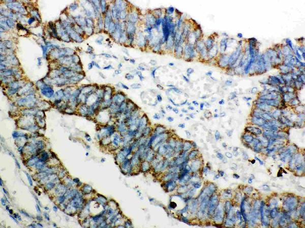 Figure 2. IHC analysis of Peroxiredoxin 3 using anti-Peroxiredoxin 3 antibody (PB9349). Peroxiredoxin 3 was detected in paraffin-embedded section of Human Intestinal Cancer Tissue. Heat mediated antigen retrieval was performed in citrate buffer (pH6, epitope retrieval solution) for 20 mins. The tissue section was blocked with 10% goat serum. The tissue section was then incubated with 1microg/ml rabbit anti-Peroxiredoxin 3 Antibody (PB9349) overnight at 4°C. Biotinylated goat anti-rabbit IgG was used as secondary antibody and incubated for 30 minutes at 37°C. The tissue section was developed using Strepavidin-Biotin-Complex (SABC)(Catalog # SA1022) with DAB as the chromogen.