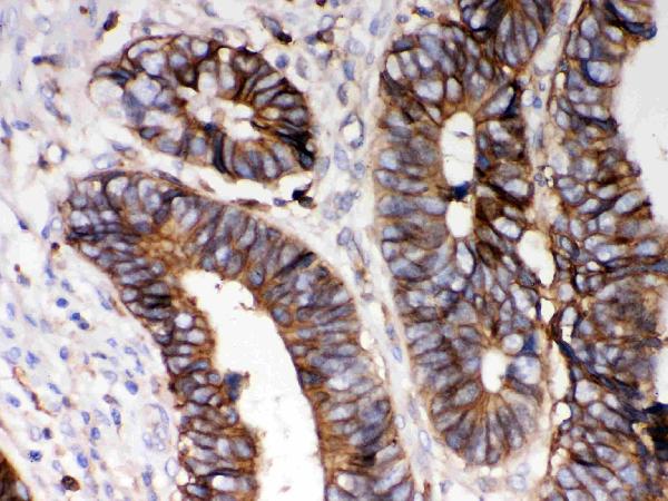 Figure 2. IHC analysis of HLA A using anti-HLA A antibody (PB9376). HLA A was detected in a paraffin-embedded section of Human Intestinal Cancer tissue. Heat mediated antigen retrieval was performed in EDTA buffer (pH 8.0, epitope retrieval solution). The tissue section was blocked with 10% goat serum. The tissue section was then incubated with 1 microg/ml rabbit anti-HLA A Antibody (PB9376) overnight at 4°C. Peroxidase Conjugated Goat Anti-rabbit IgG was used as secondary antibody and incubated for 30 minutes at 37°C. The tissue section was developed using HRP Conjugated Rabbit IgG Super Vision Assay Kit (Catalog # SV0002) with DAB as the chromogen.