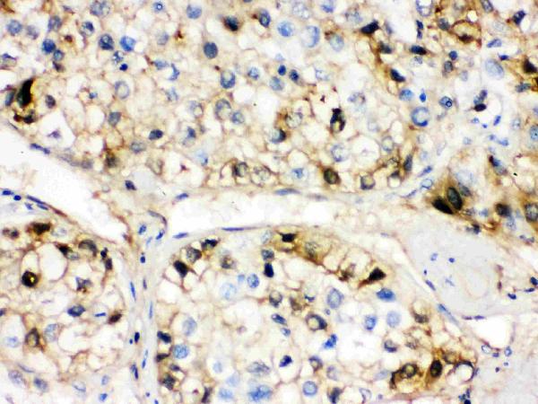 Figure 2. IHC analysis of AHSG using anti-AHSG antibody (PB9568). AHSG was detected in paraffin-embedded section of Human Liver Cancer Tissue. Heat mediated antigen retrieval was performed in citrate buffer (pH6, epitope retrieval solution) for 20 mins. The tissue section was blocked with 10% goat serum. The tissue section was then incubated with 1microg/ml rabbit anti-AHSG Antibody (PB9568) overnight at 4°C. Biotinylated goat anti-rabbit IgG was used as secondary antibody and incubated for 30 minutes at 37°C. The tissue section was developed using Strepavidin-Biotin-Complex (SABC)(Catalog # SA1022) with DAB as the chromogen.
