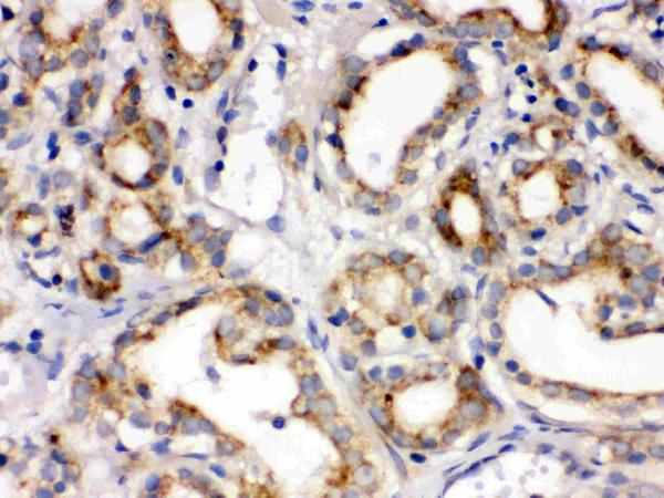 Figure 2. IHC analysis of Frizzled homolog 1 using anti-Frizzled homolog 1 antibody (PB9594). Frizzled homolog 1 was detected in a paraffin-embedded section of human prostatic cancer tissue. Heat mediated antigen retrieval was performed in EDTA buffer (pH 8.0, epitope retrieval solution). The tissue section was blocked with 10% goat serum. The tissue section was then incubated with 1 microg/ml rabbit anti-Frizzled homolog 1 Antibody (PB9594) overnight at 4°C. Biotinylated goat anti-rabbit IgG was used as secondary antibody and incubated for 30 minutes at 37°C. The tissue section was developed using Strepavidin-Biotin-Complex (SABC) (Catalog # SA1022) with DAB as the chromogen.