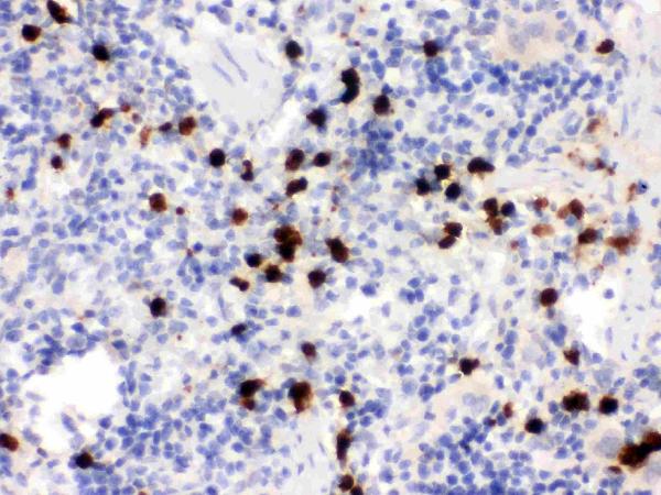 Figure 3. IHC analysis of S100A9 using anti-S100A9 antibody (PB9678). S100A9 was detected in a paraffin-embedded section of rat spleen tissue. Heat mediated antigen retrieval was performed in EDTA buffer (pH 8.0, epitope retrieval solution). The tissue section was blocked with 10% goat serum. The tissue section was then incubated with 1 microg/ml rabbit anti-S100A9 Antibody (PB9678) overnight at 4°C. Biotinylated goat anti-rabbit IgG was used as secondary antibody and incubated for 30 minutes at 37°C. The tissue section was developed using Strepavidin-Biotin-Complex (SABC) (Catalog # SA1022) with DAB as the chromogen. Figure 3. IHC analysis of S100A9 using anti-S100A9 antibody (PB9678). S100A9 was detected in a paraffin-embedded section of rat spleen tissue. Heat mediated antigen retrieval was performed in EDTA buffer (pH 8.0, epitope retrieval solution). The tissue section was blocked with 10% goat serum. The tissue section was then incubated with 1 microg/ml rabbit anti-S100A9 Antibody (PB9678) overnight at 4°C. Biotinylated goat anti-rabbit IgG was used as secondary antibody and incubated for 30 minutes at 37°C. The tissue section was developed using Strepavidin-Biotin-Complex (SABC) (Catalog # SA1022) with DAB as the chromogen.