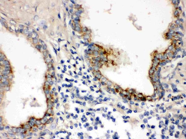 Figure 2. IHC analysis of PTP4A2 using anti-PTP4A2 antibody (PB9740). PTP4A2 was detected in paraffin-embedded section of Human Prostatic Cancer Tissue. Heat mediated antigen retrieval was performed in citrate buffer (pH6, epitope retrieval solution) for 20 mins. The tissue section was blocked with 10% goat serum. The tissue section was then incubated with 1microg/ml rabbit anti-PTP4A2 Antibody (PB9740) overnight at 4°C. Biotinylated goat anti-rabbit IgG was used as secondary antibody and incubated for 30 minutes at 37°C. The tissue section was developed using Strepavidin-Biotin-Complex (SABC)(Catalog # SA1022) with DAB as the chromogen.