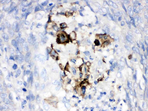 Figure 2. IHC analysis of Factor B using anti-Factor B antibody (PB9934). Factor B was detected in a paraffin-embedded section of human lung cancer tissue. Heat mediated antigen retrieval was performed in EDTA buffer (pH 8.0, epitope retrieval solution). The tissue section was blocked with 10% goat serum. The tissue section was then incubated with 1 microg/ml rabbit anti-Factor B Antibody (PB9934) overnight at 4°C. Biotinylated goat anti-rabbit IgG was used as secondary antibody and incubated for 30 minutes at 37°C. The tissue section was developed using Strepavidin-Biotin-Complex (SABC) (Catalog # SA1022) with DAB as the chromogen.