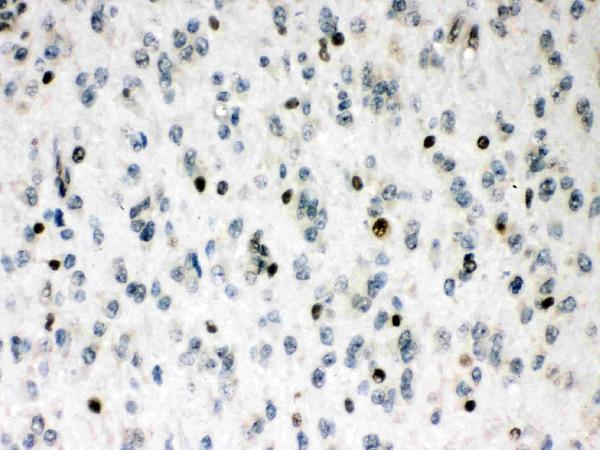 Figure 4. IHC analysis of MEF2A using anti-MEF2A antibody (PB9953). MEF2A was detected in a paraffin-embedded section of human glioma tissue. Heat mediated antigen retrieval was performed in EDTA buffer (pH 8.0, epitope retrieval solution). The tissue section was blocked with 10% goat serum. The tissue section was then incubated with 1 microg/ml rabbit anti-MEF2A Antibody (PB9953) overnight at 4°C. Biotinylated goat anti-rabbit IgG was used as secondary antibody and incubated for 30 minutes at 37°C. The tissue section was developed using Strepavidin-Biotin-Complex (SABC) (Catalog # SA1022) with DAB as the chromogen.