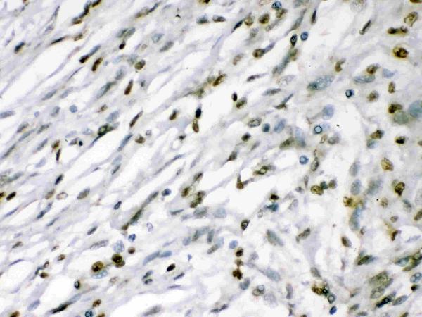 Figure 5. IHC analysis of MEF2A using anti-MEF2A antibody (PB9953). MEF2A was detected in a paraffin-embedded section of human meningeoma tissue. Heat mediated antigen retrieval was performed in EDTA buffer (pH 8.0, epitope retrieval solution). The tissue section was blocked with 10% goat serum. The tissue section was then incubated with 1 microg/ml rabbit anti-MEF2A Antibody (PB9953) overnight at 4°C. Biotinylated goat anti-rabbit IgG was used as secondary antibody and incubated for 30 minutes at 37°C. The tissue section was developed using Strepavidin-Biotin-Complex (SABC) (Catalog # SA1022) with DAB as the chromogen.