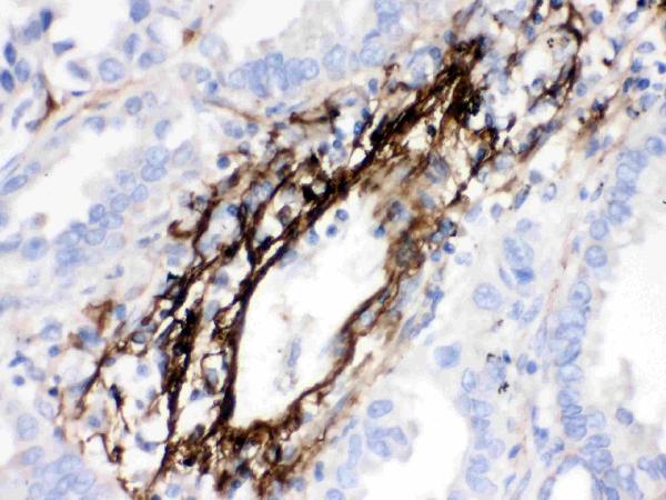 Figure 2. IHC analysis of MGP using anti-MGP antibody (PB9954). MGP was detected in a paraffin-embedded section of human lung cancer tissue. Heat mediated antigen retrieval was performed in EDTA buffer (pH 8.0, epitope retrieval solution). The tissue section was blocked with 10% goat serum. The tissue section was then incubated with 1 microg/ml rabbit anti-MGP Antibody (PB9954) overnight at 4°C. Biotinylated goat anti-rabbit IgG was used as secondary antibody and incubated for 30 minutes at 37°C. The tissue section was developed using Strepavidin-Biotin-Complex (SABC) (Catalog # SA1022) with DAB as the chromogen.