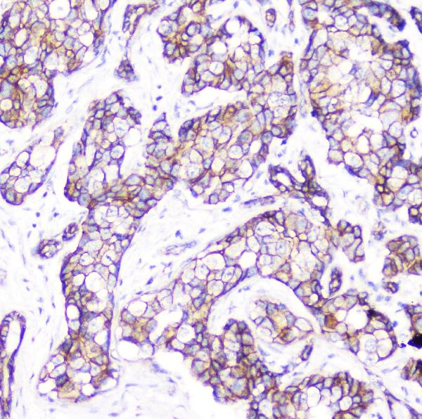 IHC analysis of beta Catenin using anti-beta Catenin antibody (M00004-2). beta Catenin was detected in paraffin-embedded section of human mammary cancer. Heat mediated antigen retrieval was performed in citrate buffer (pH6, epitope retrieval solution) for 20 mins. The tissue section was blocked with 10% goat serum. The tissue section was then incubated with 2μg/ml mouse anti-beta Catenin Antibody (M00004-2) overnight at 4°C. Biotinylated goat anti-mouse IgG was used as secondary antibody and incubated for 30 minutes at 37°C. The tissue section was developed using Strepavidin-Biotin-Complex (SABC)(Catalog # SA1021) with DAB as the chromogen.