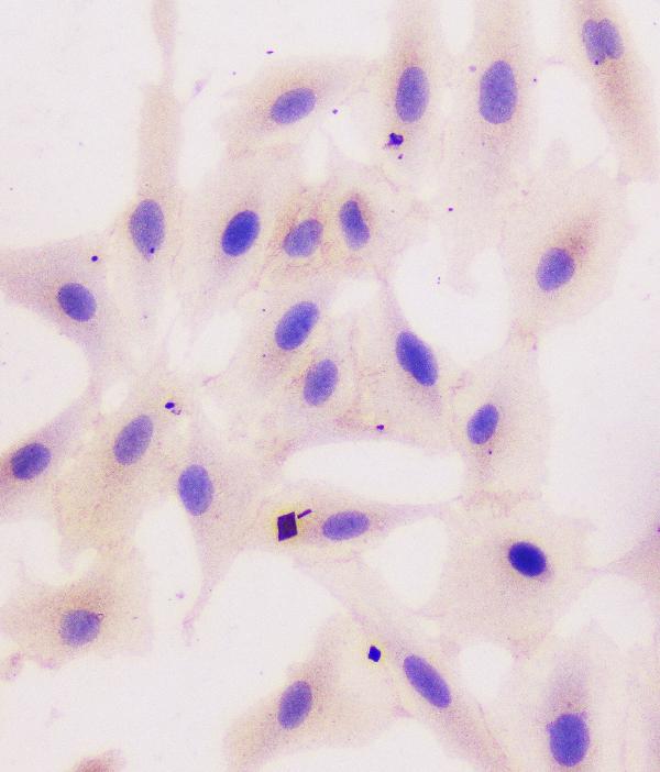IHC analysis of beta Catenin using anti-beta Catenin antibody (M00004-2). beta Catenin was detected in immunocytochemical section of A549 cell. Enzyme antigen retrieval was performed using IHC enzyme antigen retrieval reagent (AR0022) for 15 mins. The cells were blocked with 10% goat serum. And then incubated with 1μg/ml mouse anti-beta Catenin Antibody (M00004-2) overnight at 4°C. Biotinylated goat anti-mouse IgG was used as secondary antibody and incubated for 30 minutes at 37°C. The section was developed using Strepavidin-Biotin-Complex (SABC)(Catalog # SA1021) with DAB as the chromogen.