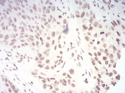 Immunohistochemical analysis of paraffin-embedded esophageal cancer tissues using TERT mouse mAb with DAB staining