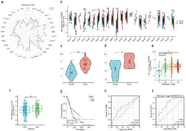 The prognosis of gastric adenocarcinoma suggests that TGFβ1 has great potential