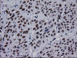 Immunohistochemical staining of paraffin-embedded Carcinoma of Human bladder tissue using anti-MYD88 mouse monoclonal antibody