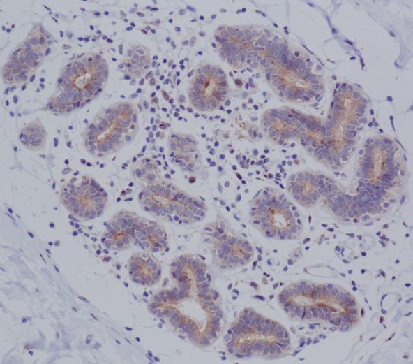Immunohistochemical analysis of paraffin-embedded human breast cancer, using MyD88 Antibody