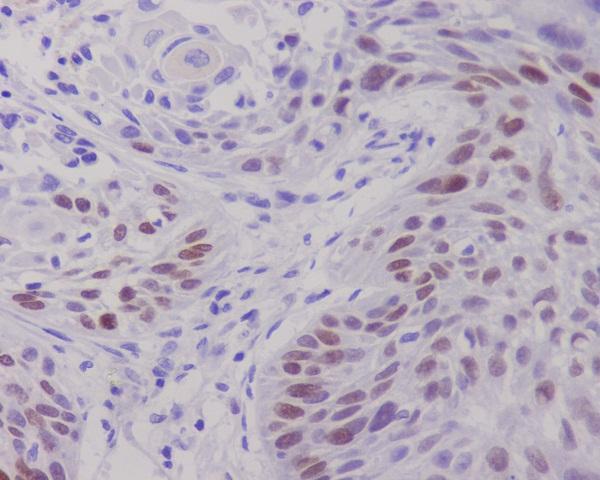 Immunohistochemical analysis of paraffin-embedded human lung cancer, using c-Myc Antibody