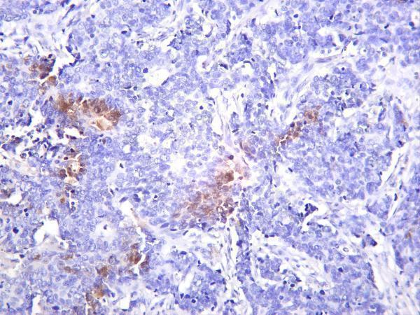 Human lung carcinoma was stained with anti-JAK2 rabbit antibody